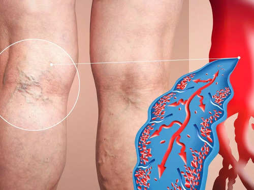 Learn About Deep Vein Thrombosis/Blood Clots